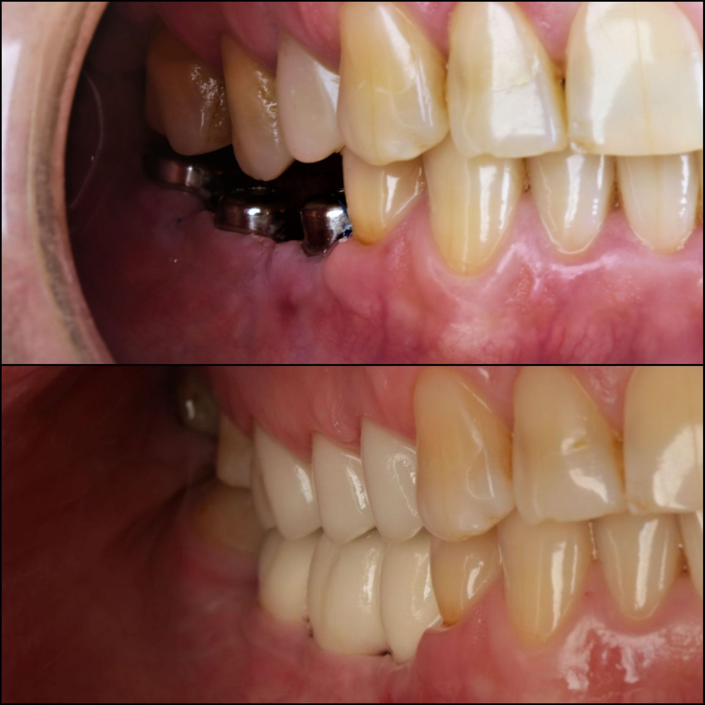 Когда мало места.Восстановление отсутсвующих зубов коронками на имплантах (нижняя челюсть) и перемещенных зубов верхней челюсти